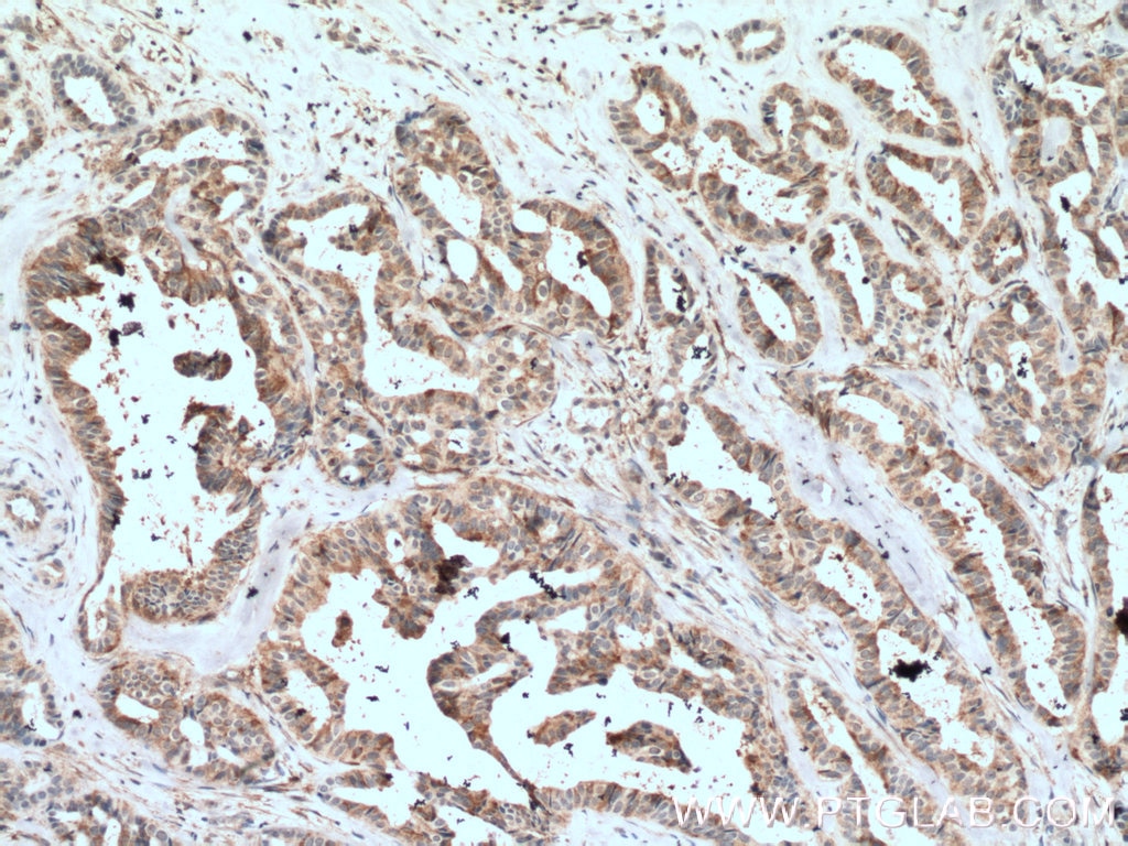 Immunohistochemistry (IHC) staining of human breast cancer tissue using VAV1 Polyclonal antibody (16364-1-AP)