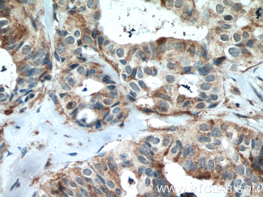 Immunohistochemistry (IHC) staining of human breast cancer tissue using VAV1 Polyclonal antibody (16364-1-AP)