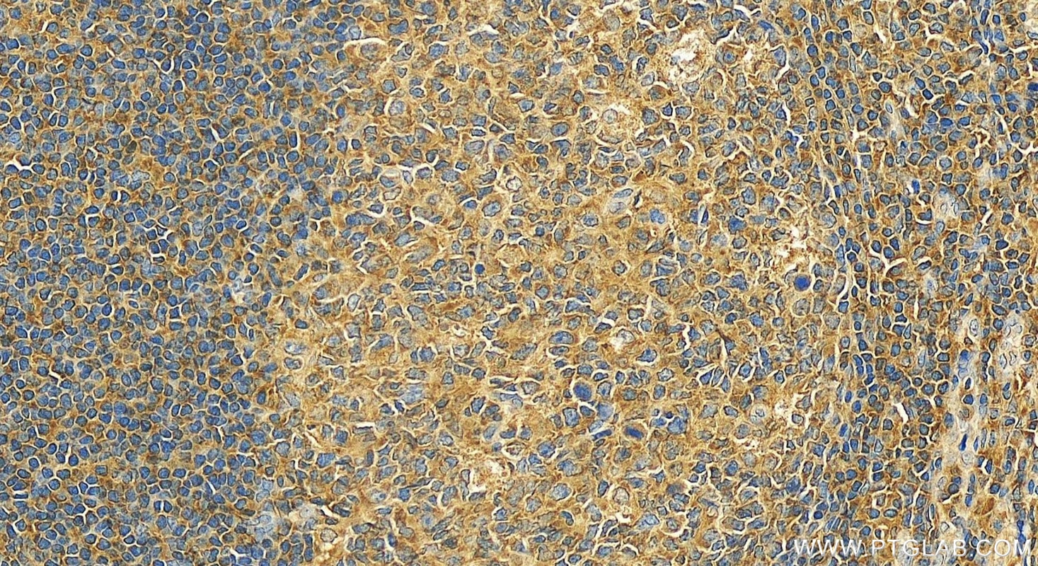 Immunohistochemistry (IHC) staining of human tonsillitis tissue using VAV1 Polyclonal antibody (16364-1-AP)