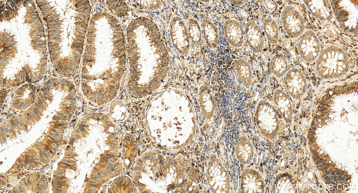 Immunohistochemistry (IHC) staining of human colon cancer tissue using VAV3 Polyclonal antibody (30291-1-AP)