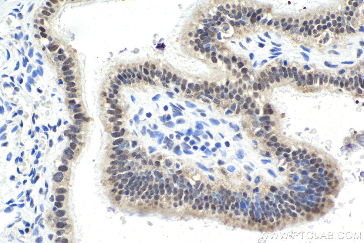 Immunohistochemistry (IHC) staining of human ovary tumor tissue using VAX2 Polyclonal antibody (15773-1-AP)