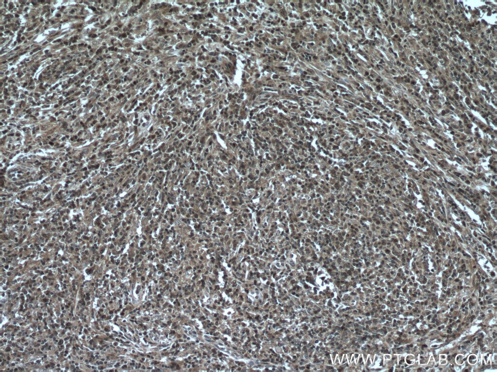 Immunohistochemistry (IHC) staining of human lymphoma tissue using VBP1 Polyclonal antibody (14345-1-AP)