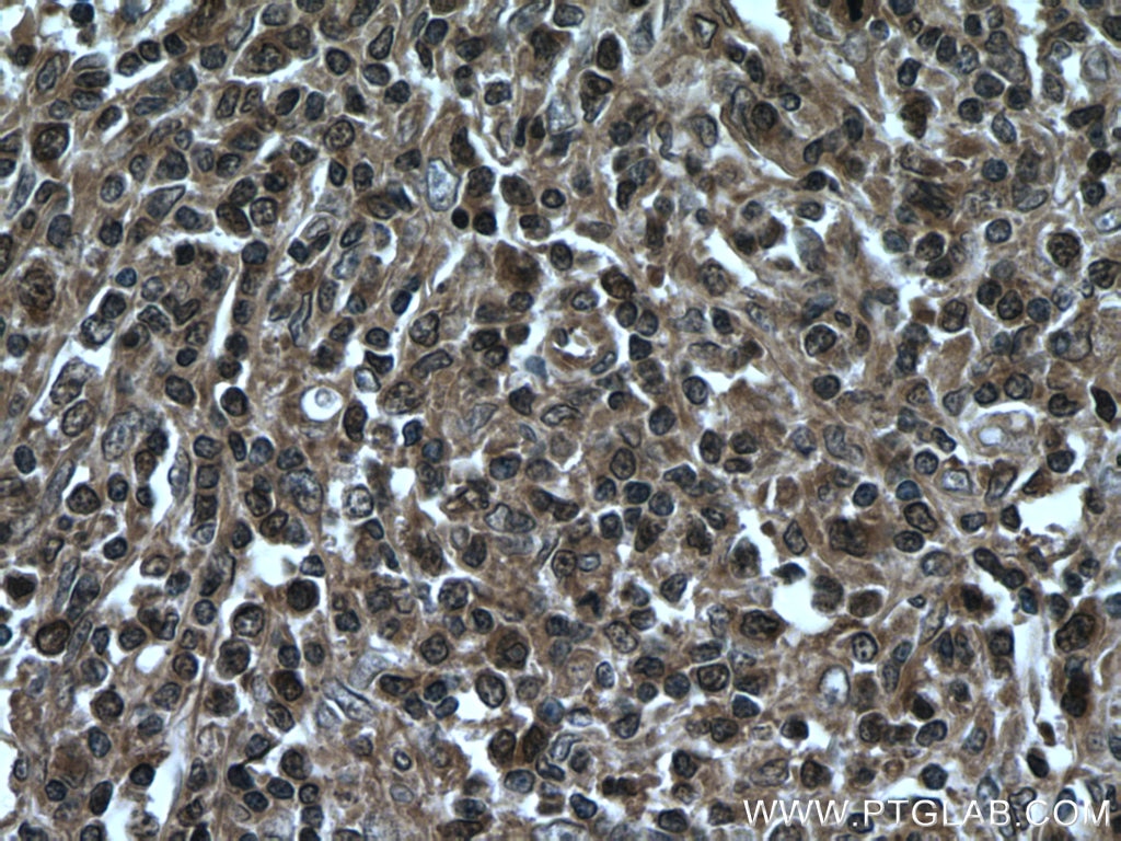 Immunohistochemistry (IHC) staining of human lymphoma tissue using VBP1 Polyclonal antibody (14345-1-AP)