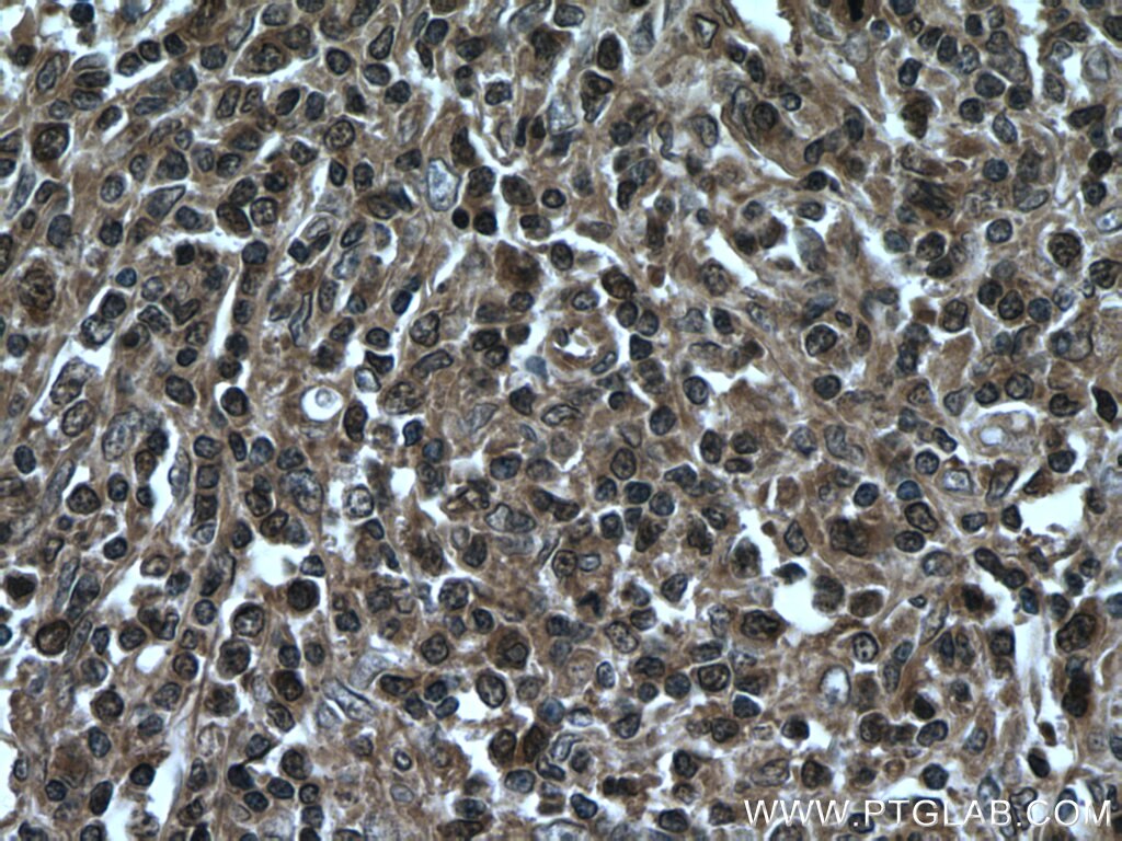 Immunohistochemistry (IHC) staining of human lymphoma tissue using VBP1 Polyclonal antibody (14345-1-AP)