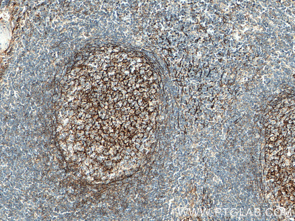 Immunohistochemistry (IHC) staining of human tonsillitis tissue using VCAM-1 Polyclonal antibody (11444-1-AP)