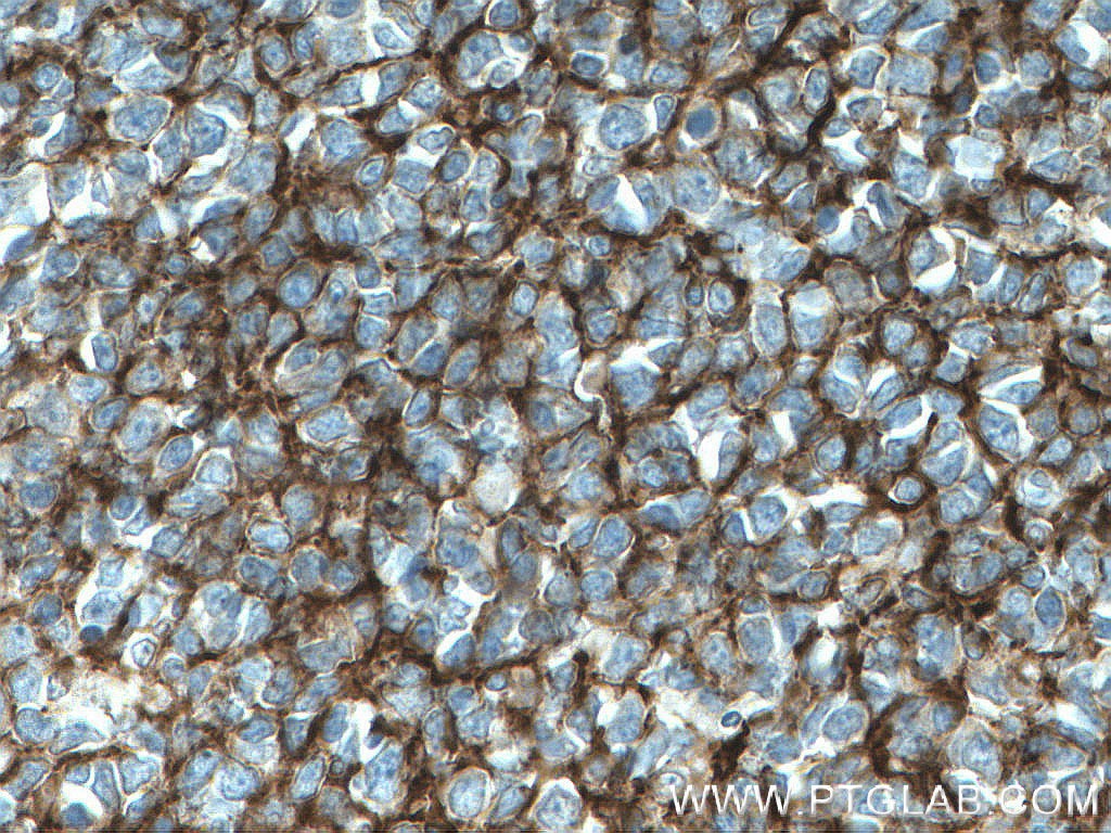 Immunohistochemistry (IHC) staining of human tonsillitis tissue using VCAM-1 Polyclonal antibody (11444-1-AP)