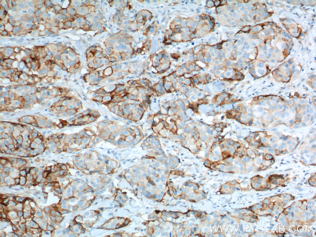 Immunohistochemistry (IHC) staining of human lung cancer tissue using VCAM-1 Polyclonal antibody (11444-1-AP)