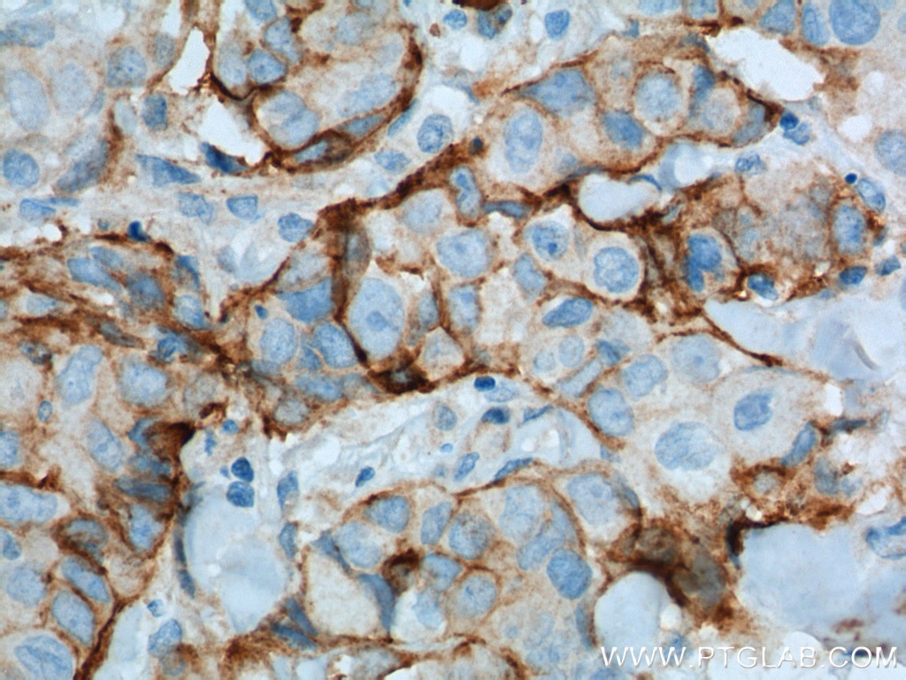 Immunohistochemistry (IHC) staining of human lung cancer tissue using VCAM-1 Polyclonal antibody (11444-1-AP)