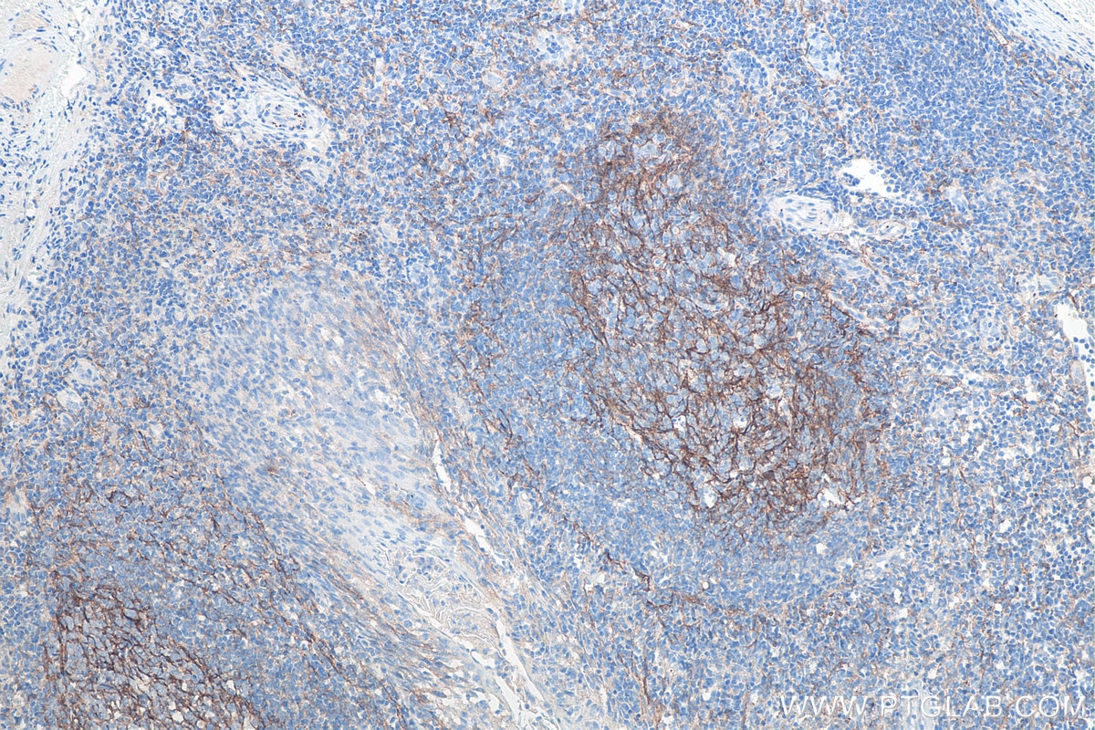 Immunohistochemistry (IHC) staining of human tonsillitis tissue using VCAM-1 Monoclonal antibody (66294-1-Ig)