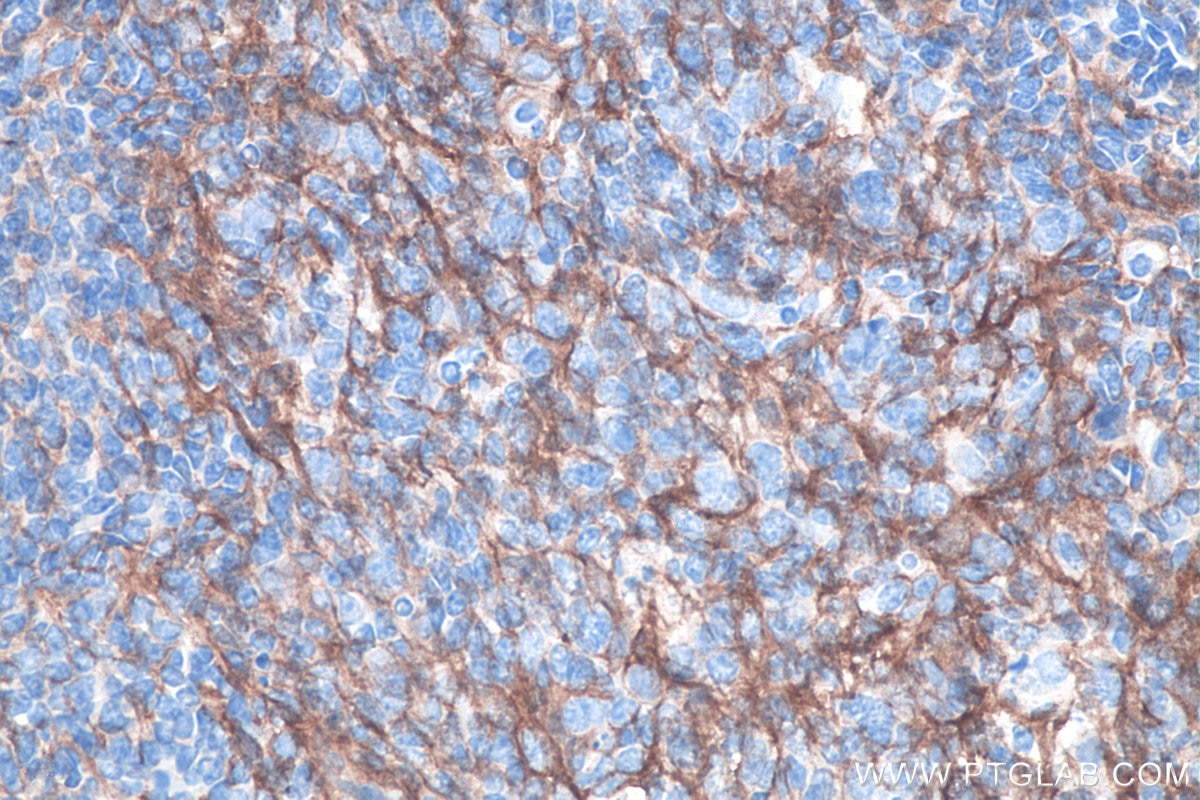 Immunohistochemistry (IHC) staining of human tonsillitis tissue using VCAM-1 Monoclonal antibody (66294-1-Ig)