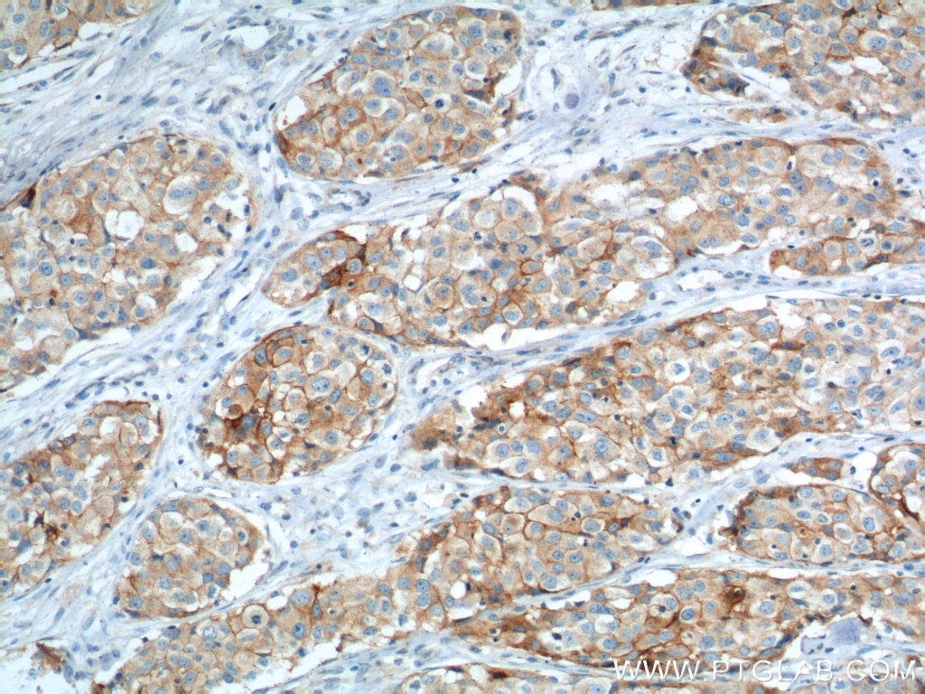 Immunohistochemistry (IHC) staining of human lung cancer tissue using VCAM-1 Monoclonal antibody (66294-1-Ig)