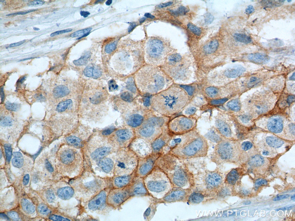 Immunohistochemistry (IHC) staining of human lung cancer tissue using VCAM-1 Monoclonal antibody (66294-1-Ig)