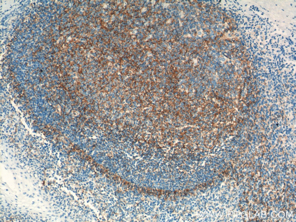 Immunohistochemistry (IHC) staining of human tonsillitis tissue using VCAM-1 Monoclonal antibody (66294-1-Ig)