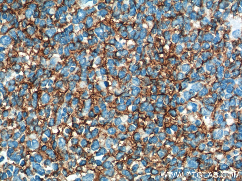 Immunohistochemistry (IHC) staining of human tonsillitis tissue using VCAM-1 Monoclonal antibody (66294-1-Ig)