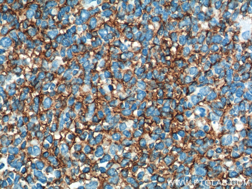 IHC staining of human tonsillitis using 66294-1-Ig