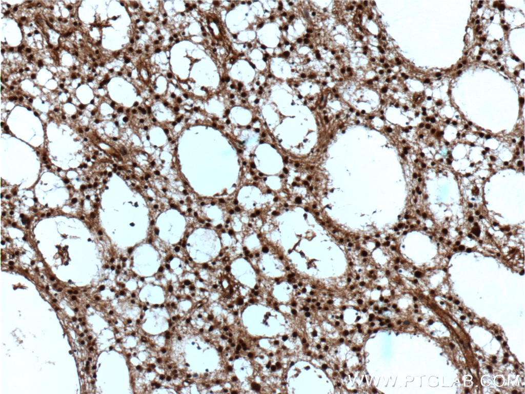 IHC staining of human gliomas using 10736-1-AP