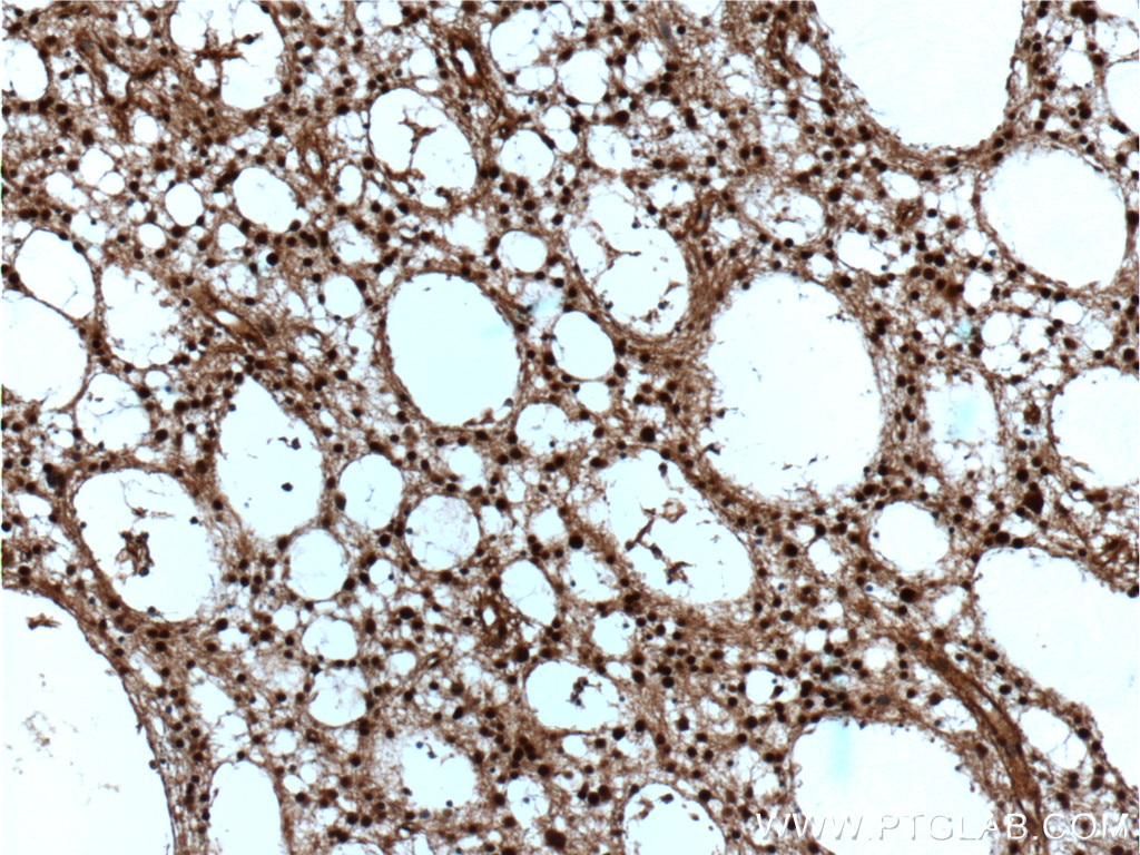 Immunohistochemistry (IHC) staining of human gliomas tissue using VCP Polyclonal antibody (10736-1-AP)