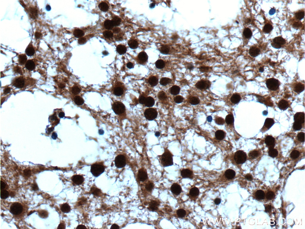 Immunohistochemistry (IHC) staining of human gliomas tissue using VCP Polyclonal antibody (10736-1-AP)