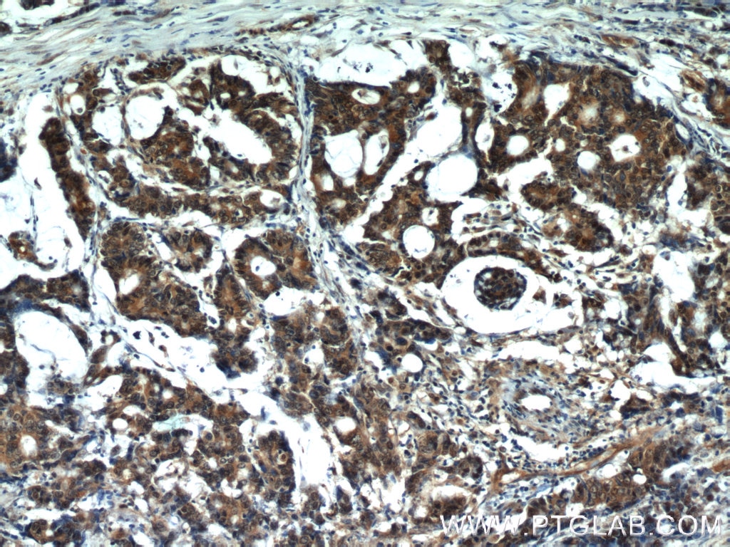 Immunohistochemistry (IHC) staining of human colon cancer tissue using VCP Polyclonal antibody (10736-1-AP)