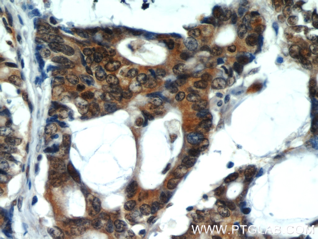 Immunohistochemistry (IHC) staining of human colon cancer tissue using VCP Polyclonal antibody (10736-1-AP)