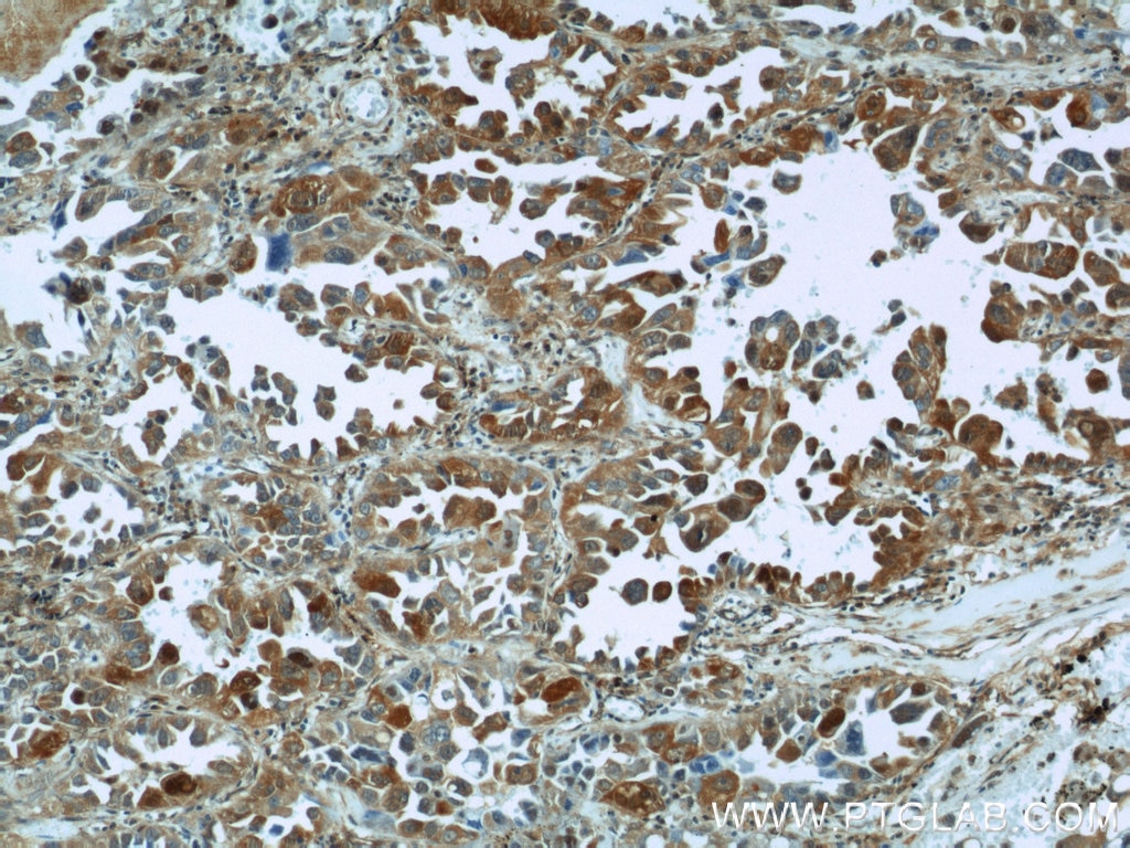 Immunohistochemistry (IHC) staining of human lung cancer tissue using VCP Polyclonal antibody (10736-1-AP)