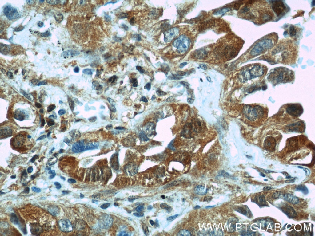 Immunohistochemistry (IHC) staining of human lung cancer tissue using VCP Polyclonal antibody (10736-1-AP)