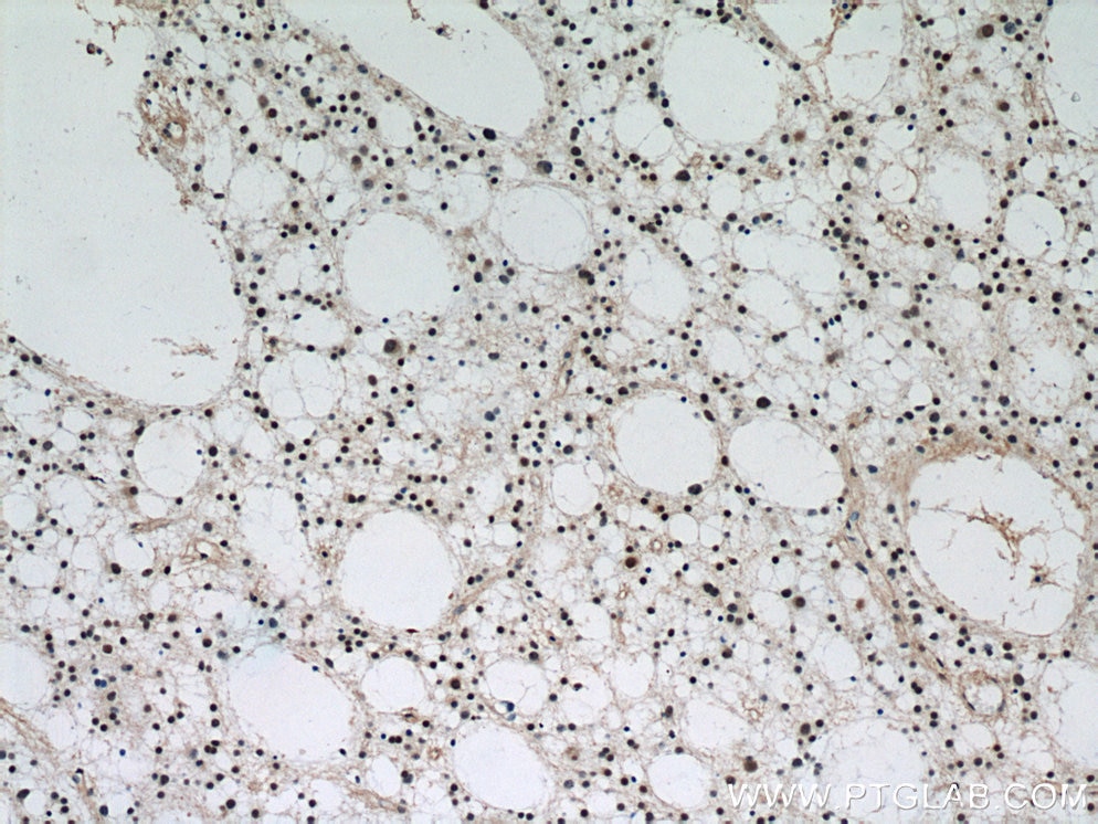 Immunohistochemistry (IHC) staining of human gliomas tissue using VCP Polyclonal antibody (10736-1-AP)