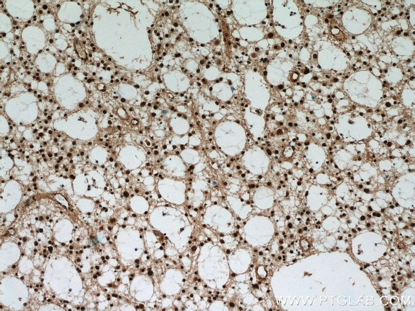 IHC staining of human gliomas using 10736-1-AP