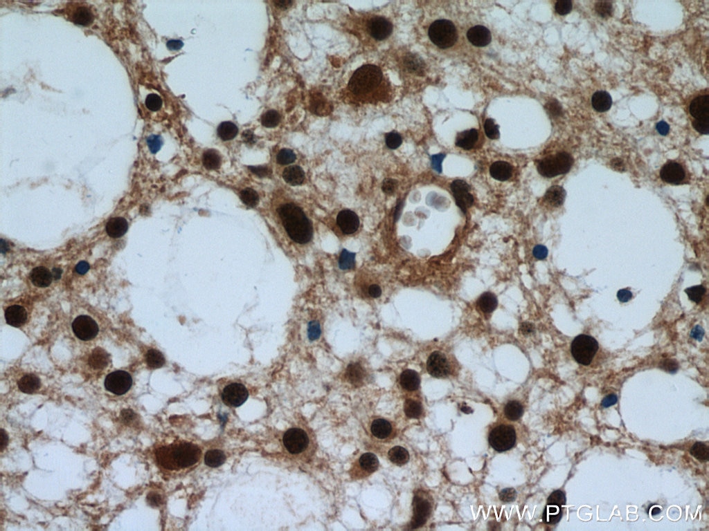 Immunohistochemistry (IHC) staining of human gliomas tissue using VCP Polyclonal antibody (10736-1-AP)