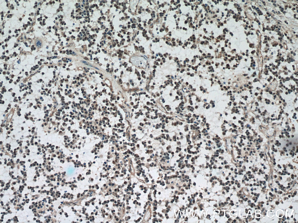 Immunohistochemistry (IHC) staining of human gliomas tissue using VCP Monoclonal antibody (60316-1-Ig)