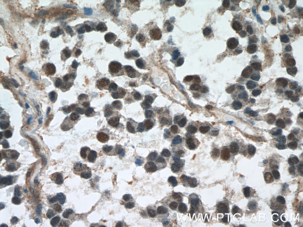 Immunohistochemistry (IHC) staining of human gliomas tissue using VCP Monoclonal antibody (60316-1-Ig)