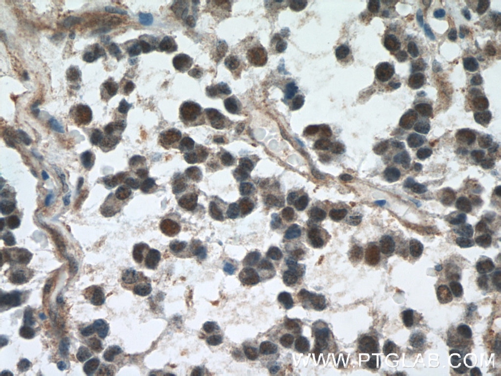 IHC staining of human gliomas using 60316-1-Ig