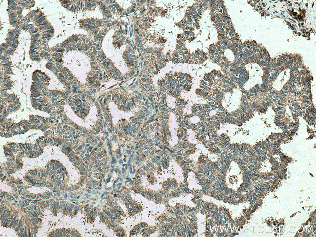 Immunohistochemistry (IHC) staining of human ovary tumor tissue using VCPIP1 Polyclonal antibody (17802-1-AP)