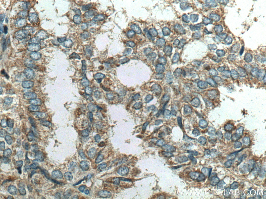 Immunohistochemistry (IHC) staining of human ovary tumor tissue using VCPIP1 Polyclonal antibody (17802-1-AP)