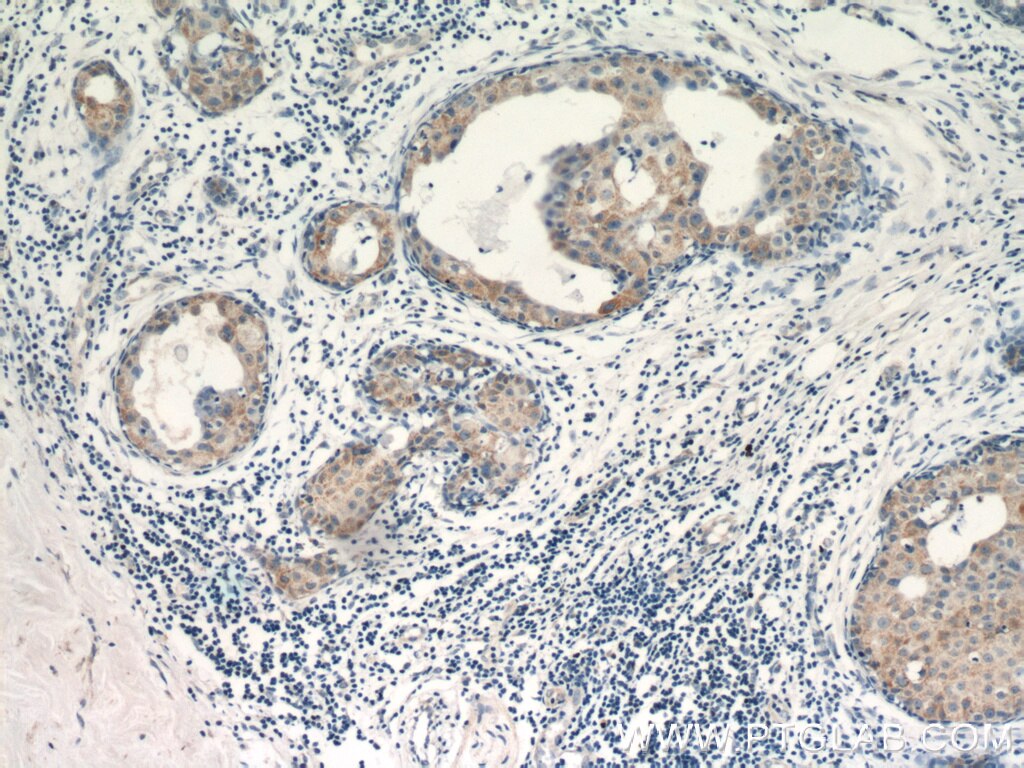 Immunohistochemistry (IHC) staining of human breast cancer tissue using VCPIP1 Polyclonal antibody (17802-1-AP)
