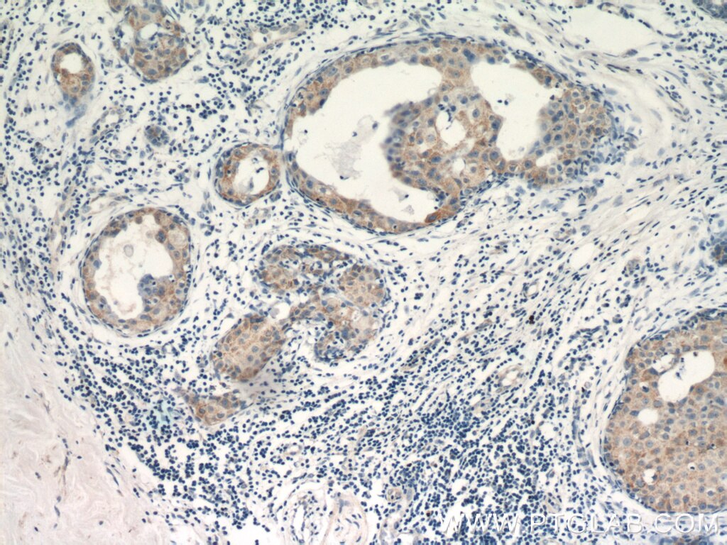 Immunohistochemistry (IHC) staining of human breast cancer tissue using VCPIP1 Polyclonal antibody (17802-1-AP)