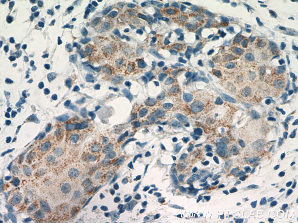 Immunohistochemistry (IHC) staining of human breast cancer tissue using VCPIP1 Polyclonal antibody (17802-1-AP)