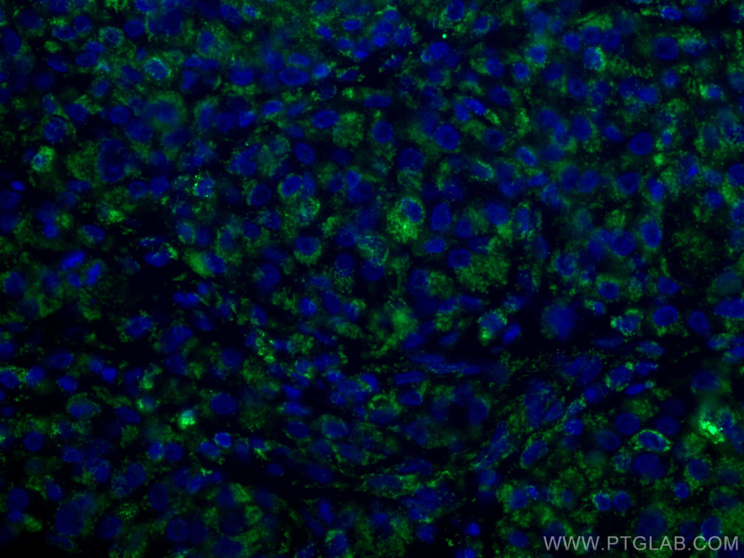 Immunofluorescence (IF) / fluorescent staining of human liver cancer tissue using VDAC1/2 Polyclonal antibody (10866-1-AP)