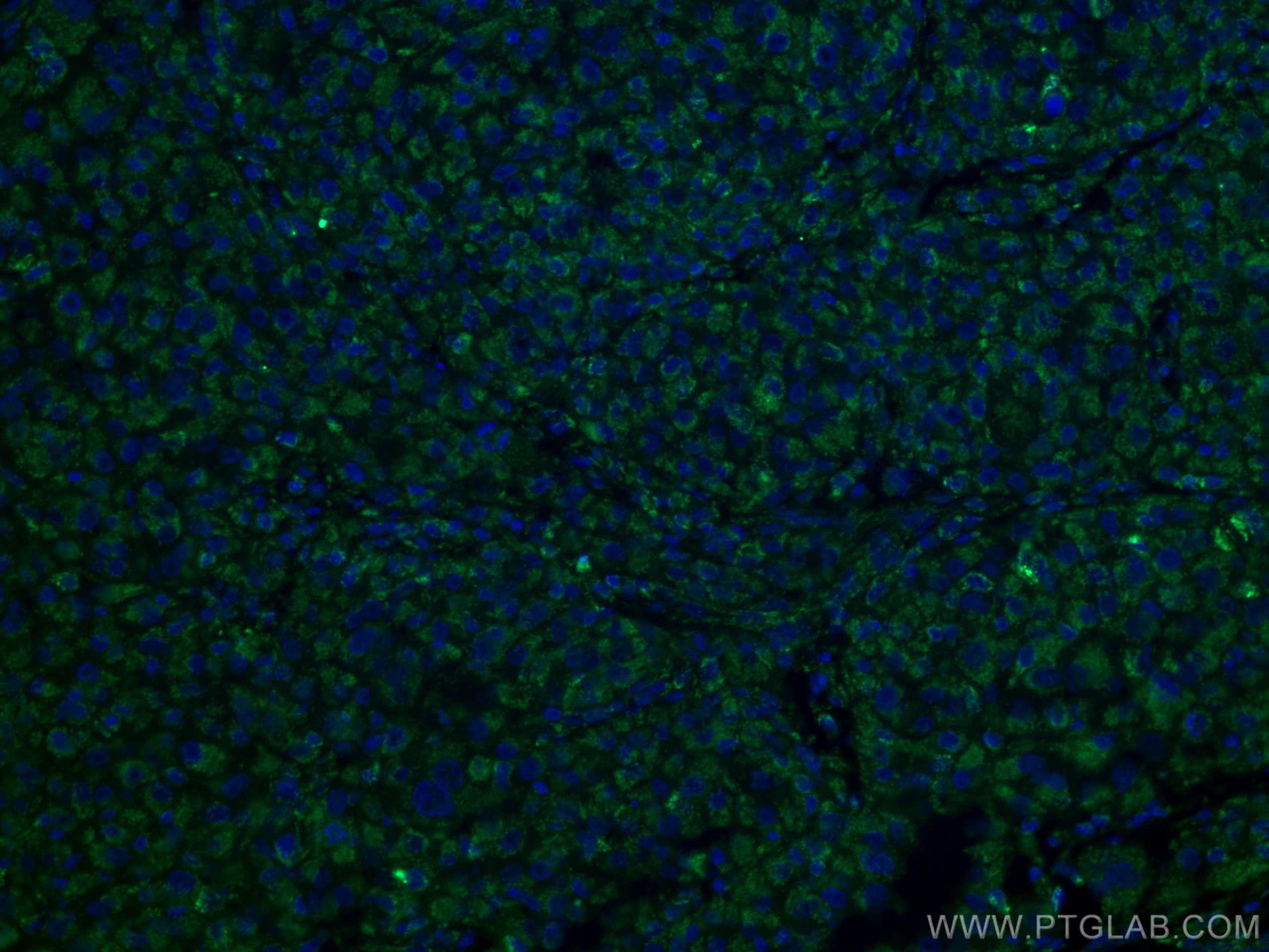 Immunofluorescence (IF) / fluorescent staining of human liver cancer tissue using VDAC1/2 Polyclonal antibody (10866-1-AP)