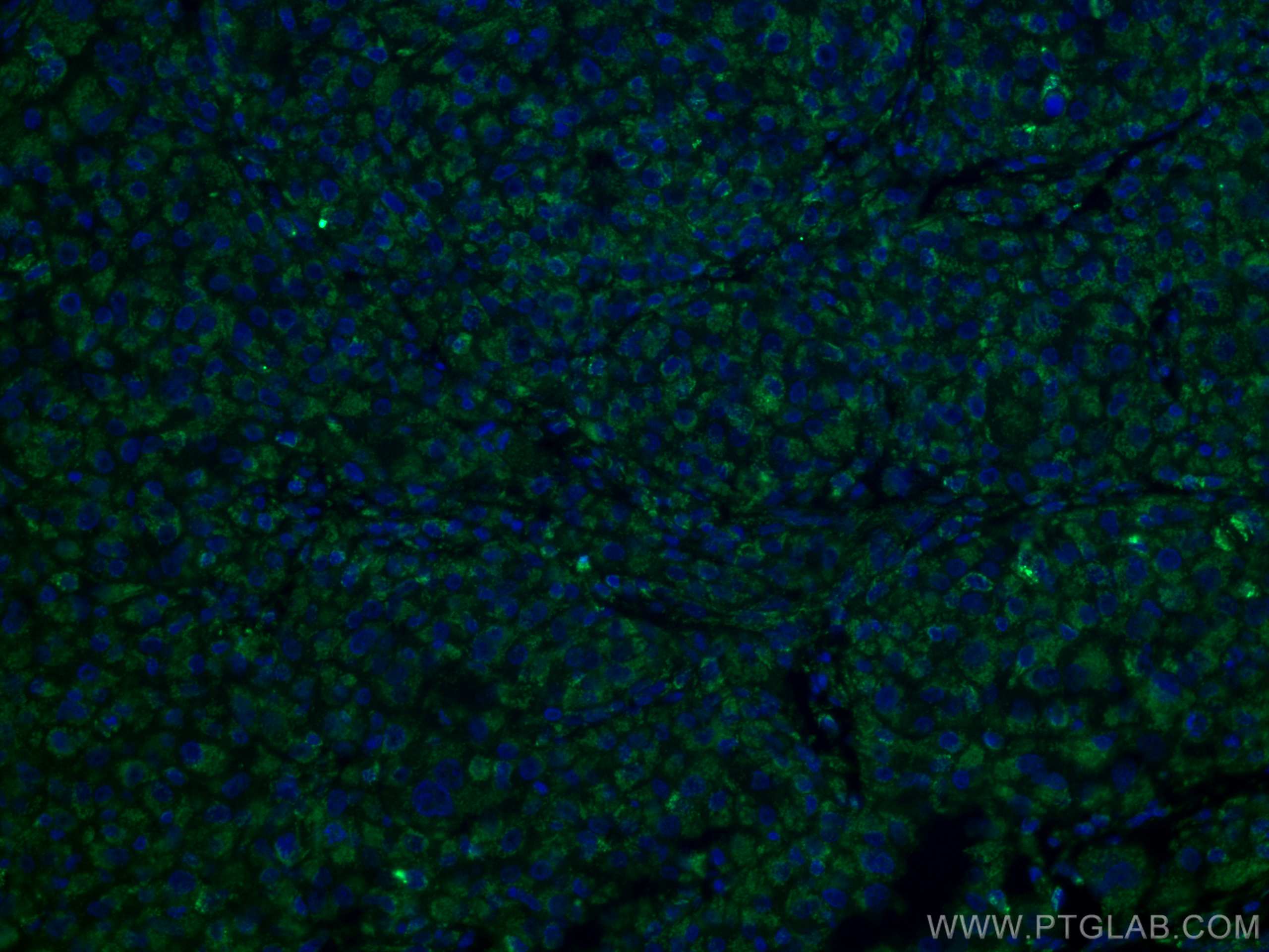 IF Staining of human liver cancer using 10866-1-AP