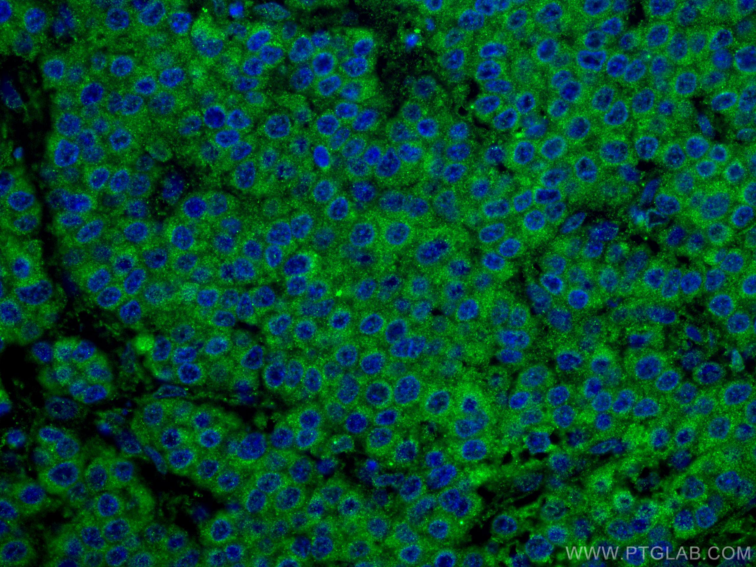 Immunofluorescence (IF) / fluorescent staining of human liver cancer tissue using VDAC1/Porin Polyclonal antibody (55259-1-AP)