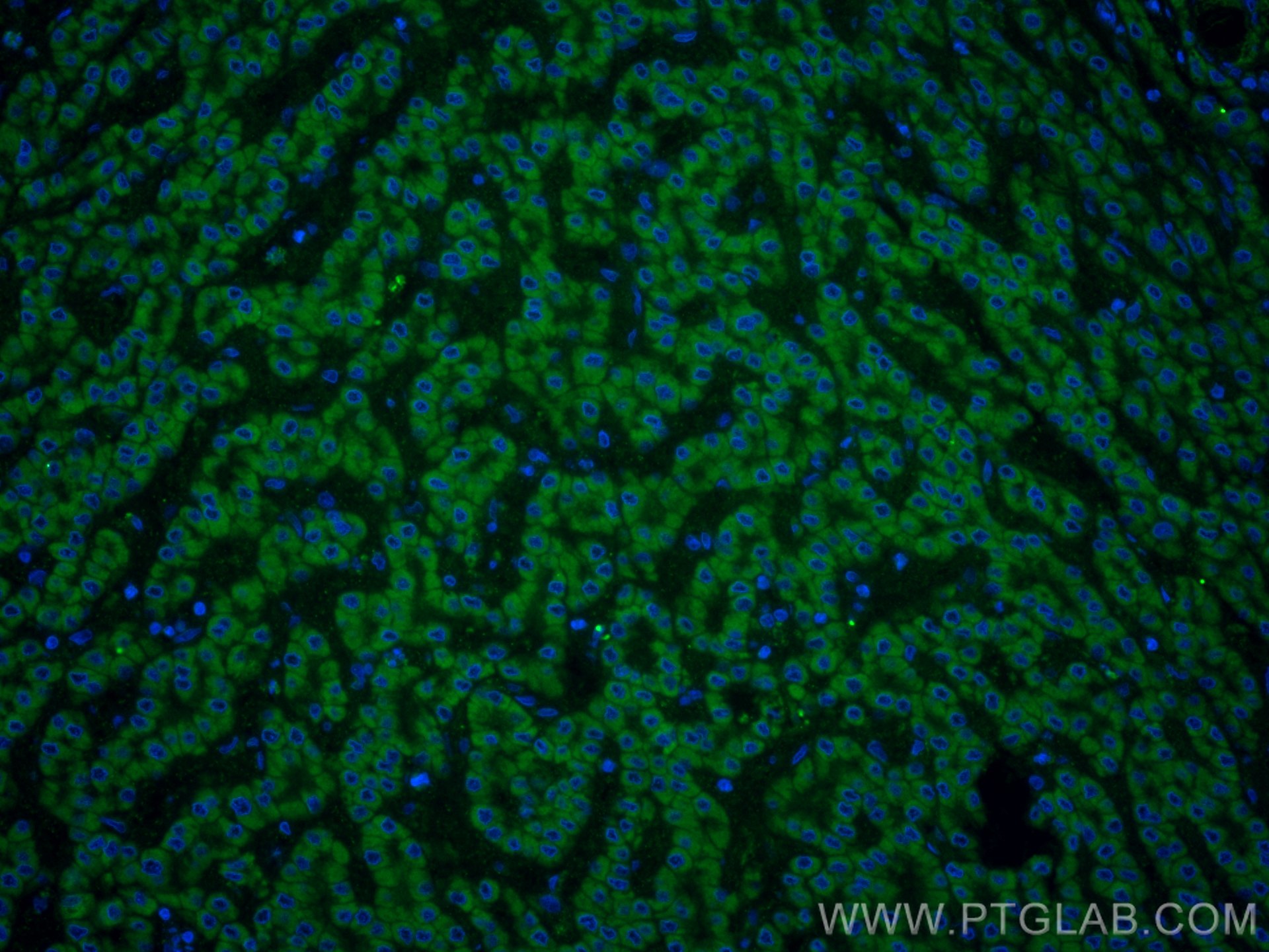 Immunofluorescence (IF) / fluorescent staining of human liver cancer tissue using CoraLite® Plus 488-conjugated VDAC1/Porin Polyclon (CL488-55259)