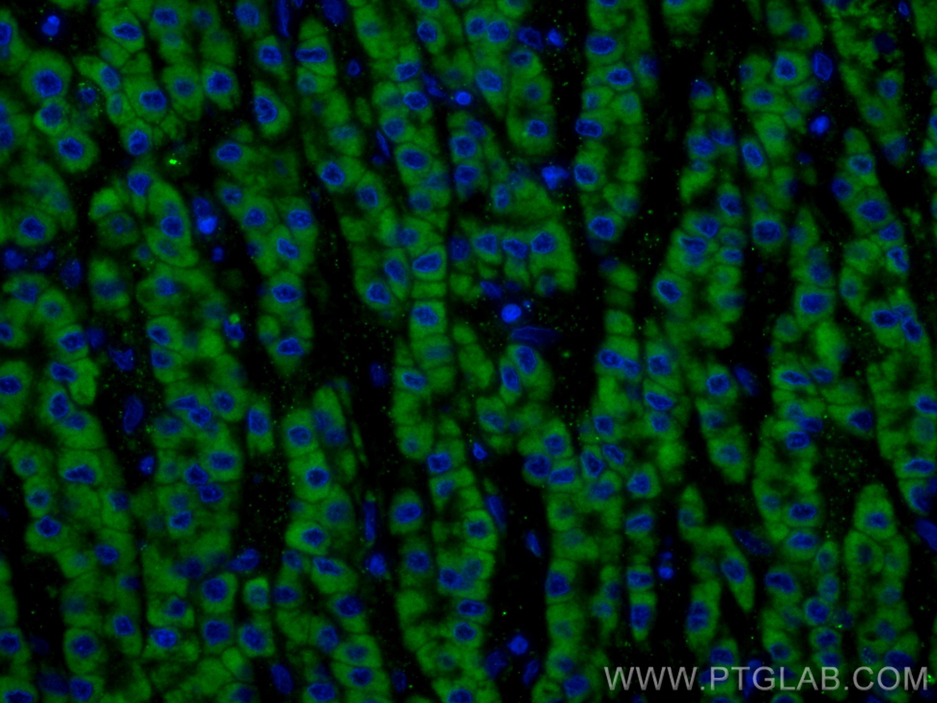 Immunofluorescence (IF) / fluorescent staining of human liver cancer tissue using CoraLite® Plus 488-conjugated VDAC1/Porin Polyclon (CL488-55259)