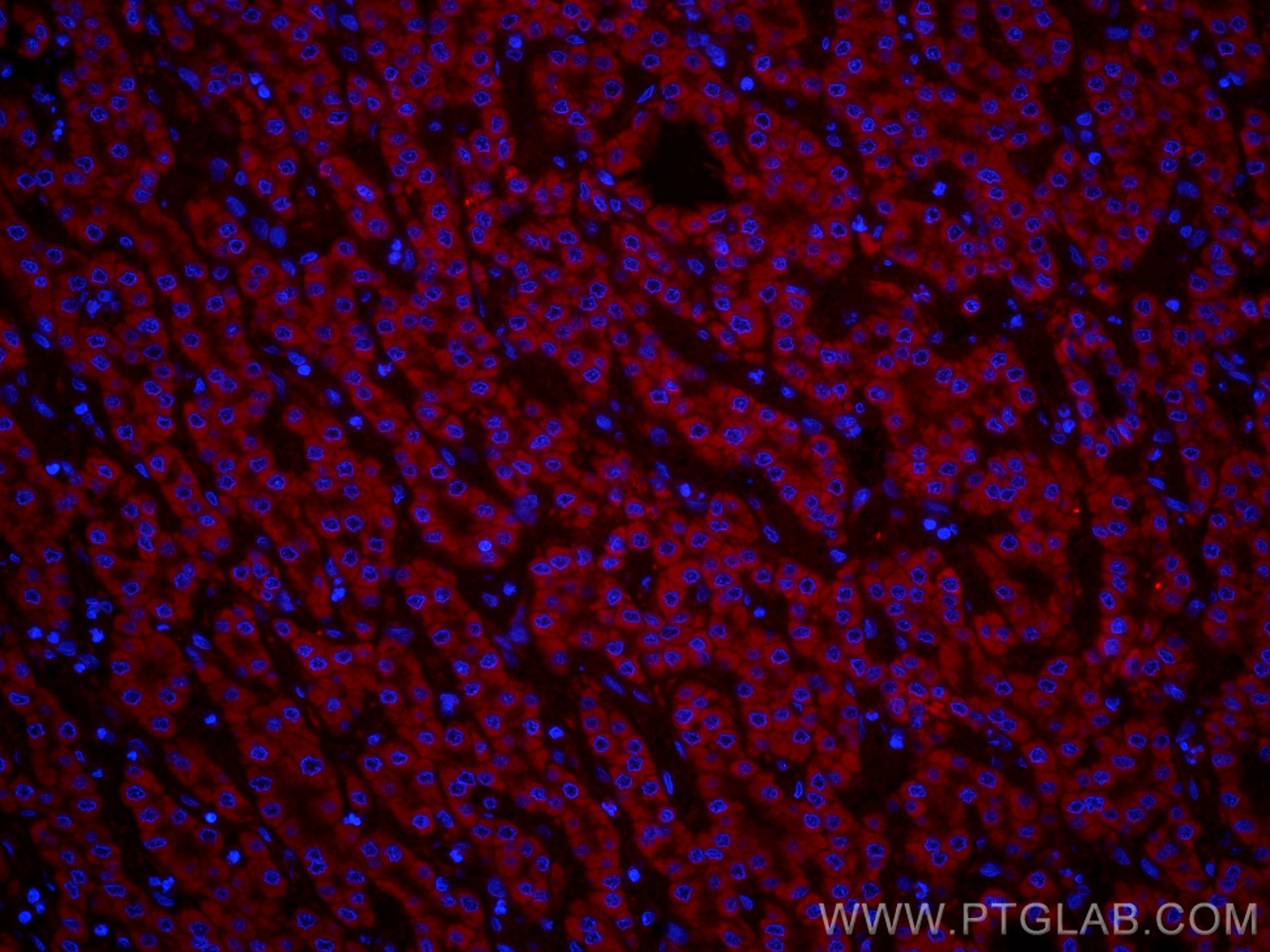 Immunofluorescence (IF) / fluorescent staining of human liver cancer tissue using CoraLite®555-conjugated VDAC1/Porin Polyclonal ant (CL555-55259)