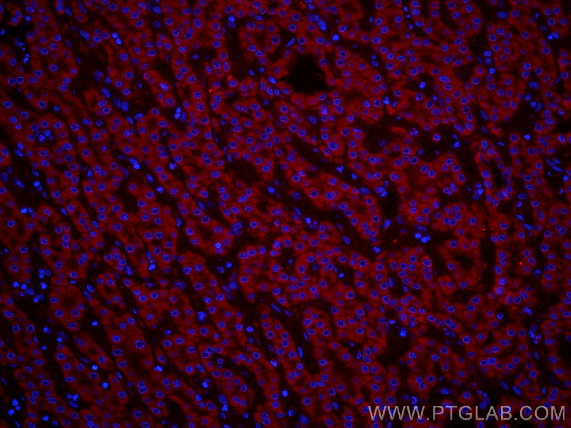 IF Staining of human liver cancer using CL555-55259