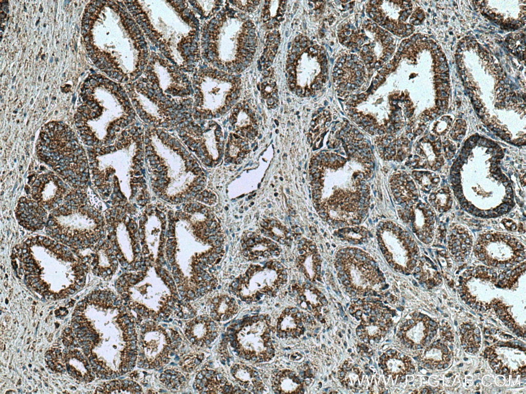 Immunohistochemistry (IHC) staining of human prostate cancer tissue using VDAC1/2/3 Polyclonal antibody (11663-1-AP)