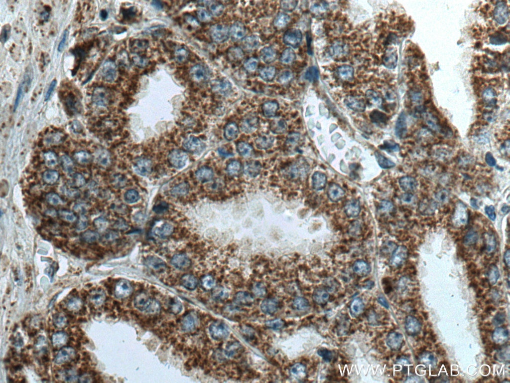 Immunohistochemistry (IHC) staining of human prostate cancer tissue using VDAC2 Polyclonal antibody (11663-1-AP)