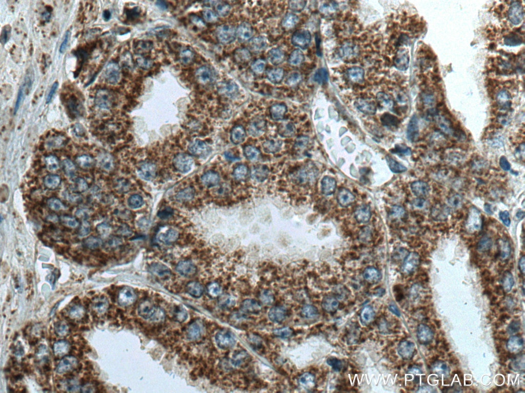 Immunohistochemistry (IHC) staining of human prostate cancer tissue using VDAC1/2/3 Polyclonal antibody (11663-1-AP)