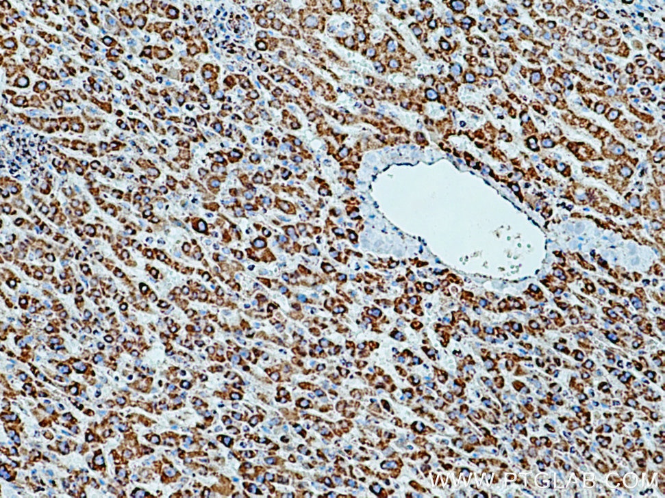 Immunohistochemistry (IHC) staining of human liver cancer tissue using VDAC3 Polyclonal antibody (14451-1-AP)