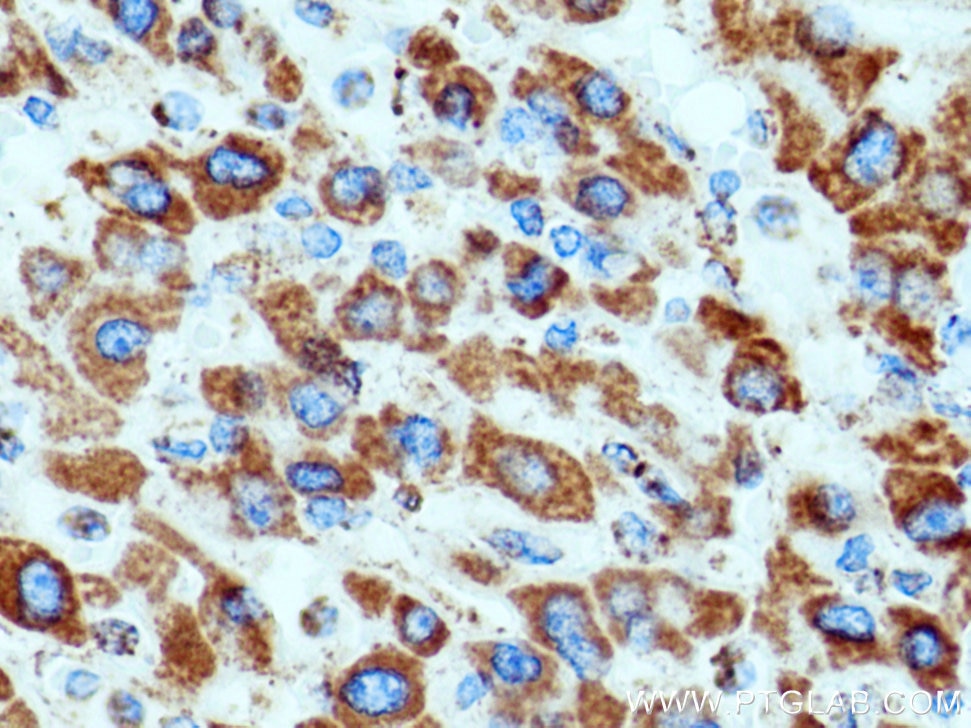 Immunohistochemistry (IHC) staining of human liver cancer tissue using VDAC3 Polyclonal antibody (14451-1-AP)